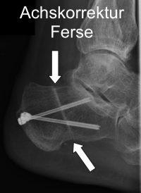 Рентген после корригирующей операции пяточной кости. Остеотомия деформированной кости может восстановить линию нагрузки нижней конечности. © Gelenk-Klinik