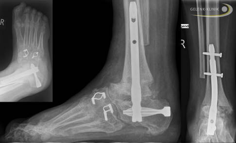 Charcot-Marie-Tooth: Symptome, Ursachen, Behandlung ...