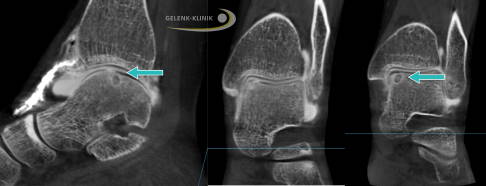 Digitale Volumentomografie des Sprunggelenks