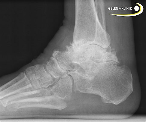 Röntgenaufnahme Arthrose im Sprunggelenk, seitlich