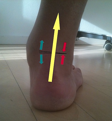 The defective position of the ankle is also visible from outside. Also shown in yellow is the altered direction of movement of the Achilles tendon. This strongest tendon in the human body intensifies the defective position by deviating from the static stress axis.