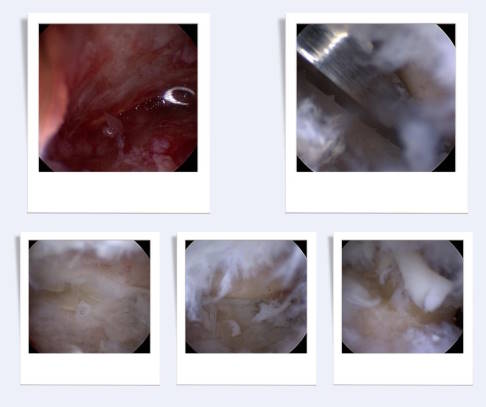 Arthroskopische Arthrodese des Subtalargelenks