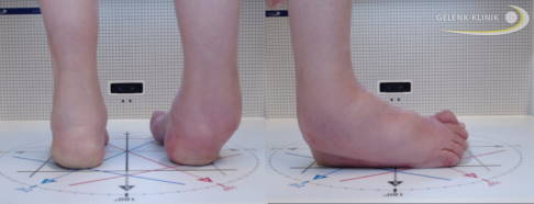 klinisches Bild einer Fußdeformierung durch Charcot-Marie-Tooth