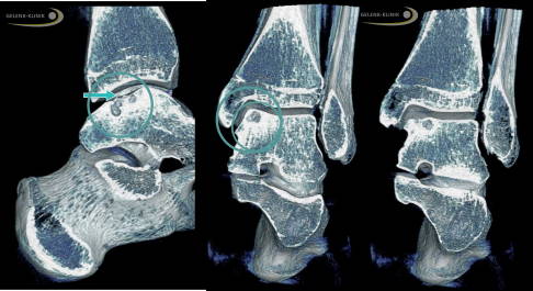 Die digitale Volumentomografie zeigt eine osteochondrale Läsion am Sprunggelenk.