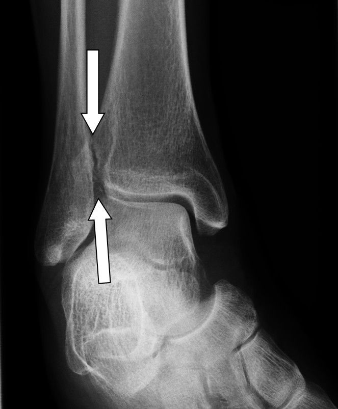 Defective position of the talar mortise results in hyper flexibility of the ankle. The arrows show the missing congruence between the shin (tibia) and calf bone (fibula) following a syndesmosis rupture.