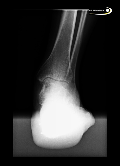 Röntgenaufnahme einer Fehlstellung des Rückfußes nach Fersenbeinfraktur.
