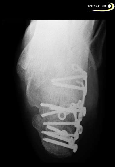Röntgenaufnahme einer komplexen Fersenbeinfraktur nach der operativen Erstversorgung