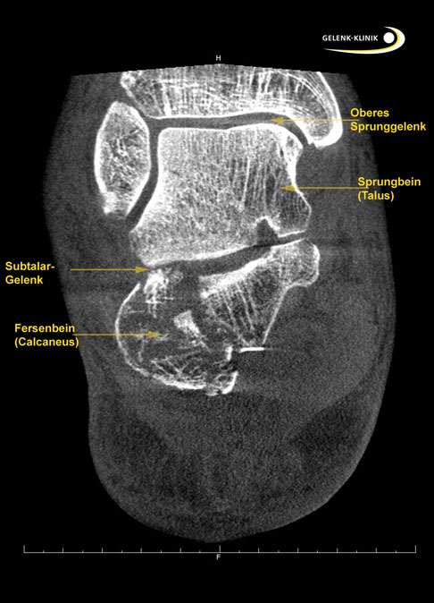 Fersenbeinbruch Calcaneusfraktur Langzeitfolgen Fehlstellung Und Arthrose Der Fussgelenke Gelenk Klinik De