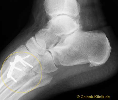 Versteifung (Arthrodese) der Fußgelenke (Fußwurzelgelenke) nach Arthrose mit einer Platte und Schrauben