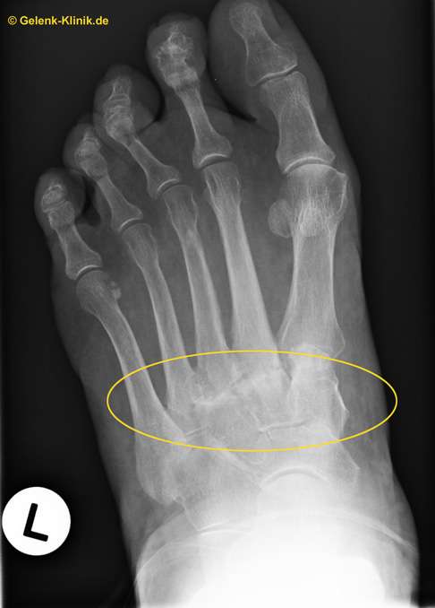 Darstellung des Lisfranc-Gelenks (tarsometatarsales Gelenk) mit Arthrose im Röntgenbild.