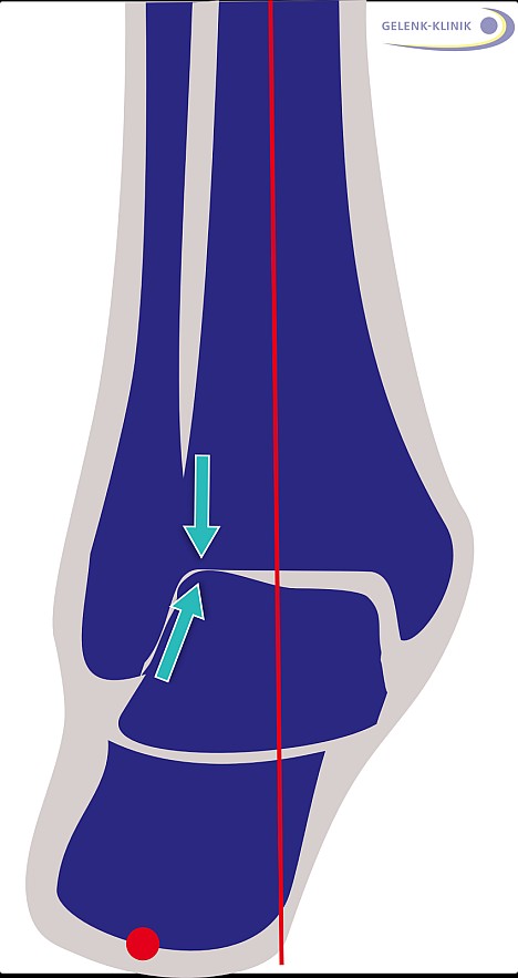 Shown in red is the normal axis of the ankle. Different causes can result in a variance which can cause arthritis of the ankle due to incorrect weight bearing.