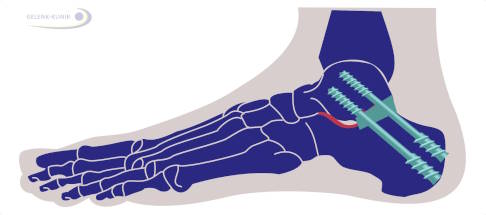 Grafik Fußskelett mit subtalarer Arthrodese