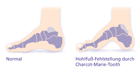 Hohlfuß-Fehlstellung durch Charcot-Marie-Tooth