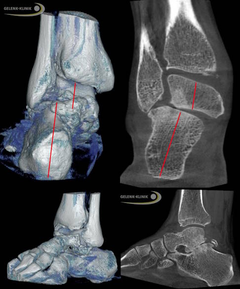 DVT und Schichtauswertung bei massiver Arthrose und instabilem Fersenbein