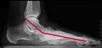 Röntgen: Knick-Senkfuß (Pes planovalgus)