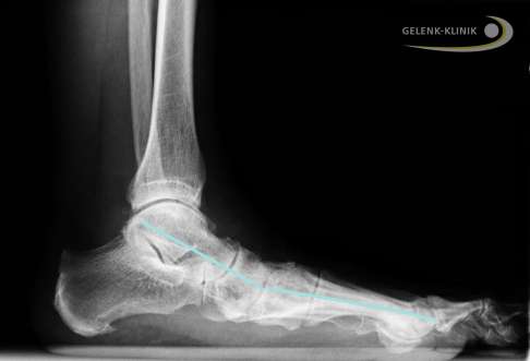 Arthrose im Sprunggelenk durch Fehlstellung des Fußes