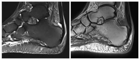 MRT der Achillessehne mit Schädigung am Sehnenansatz und Schleimbeutelentzündung.