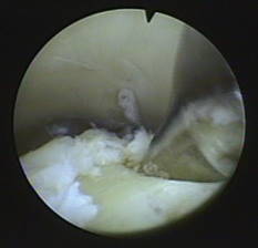 Arthroskopische Sicht einer Mikrofrakturierung (Knochenanbohrung)