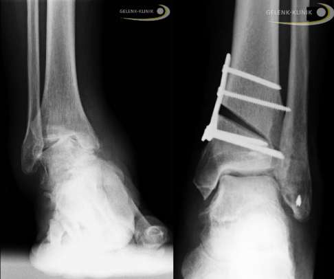 Image of right ankle (a) and left ankle (b) of the patient showing