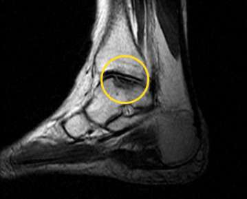 МРТ Osteochondrosis dissecans таранной кости. Обозначение полукруглой некротической области таранной кости, скопление жидкости. Osteochondrosis dissecans разрушает ровную поверхность костных структур. © Gelenk-Klinik