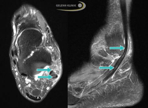 Split der kurzen Peronealsehne in einer MRT-Aufnahme