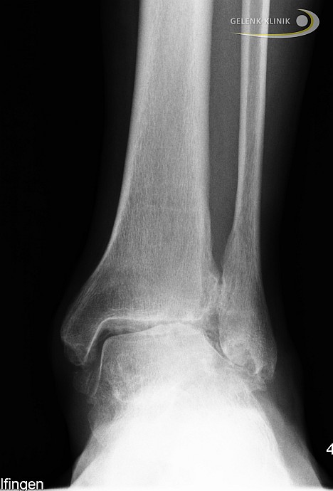 The bone surfaces in the ankle are no longer congruent. Due to the slant, only the inner (medial) part of the ankle bone from below bears weight. Arthritis can form here due to overstressing. 