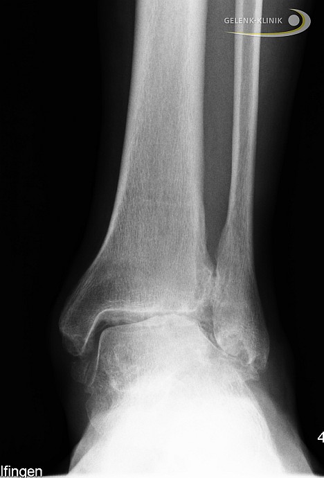 Ankle joint distortion - Bort