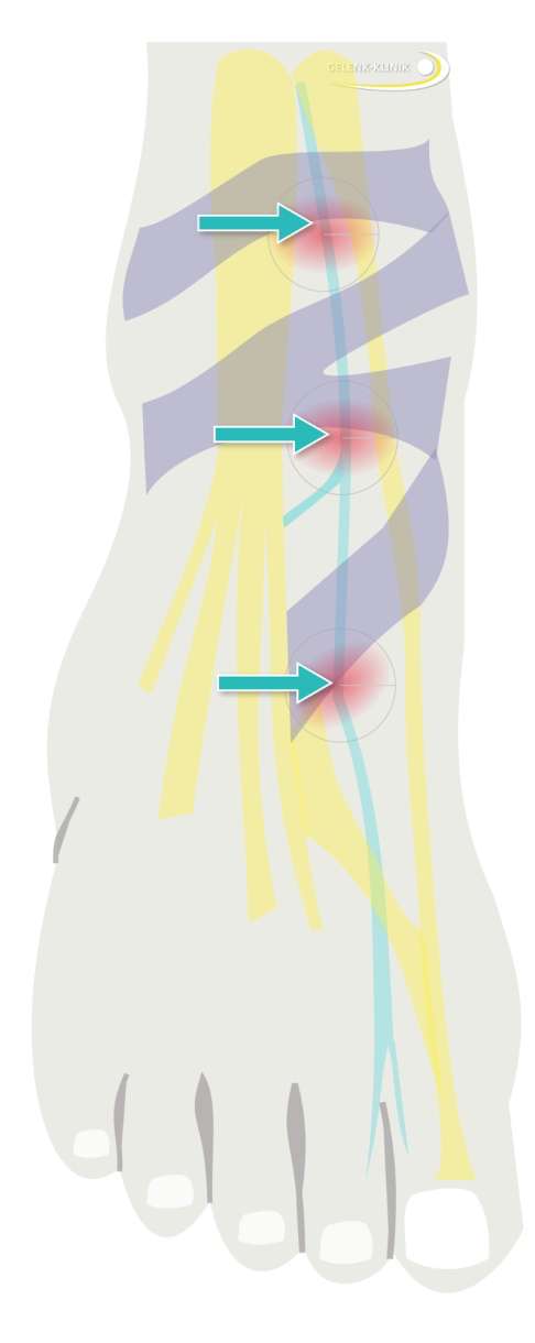 Schematische Darstellung des Tarsaltunnelsyndroms