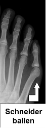 Röntgenbild eines Fußes mit Schneiderballen: Das Zehenköpfchen des 5. Zehs steht über. © Gelenk-Klinik