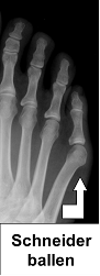 Röntgenbild eines Schneiderballen: Der Winkel zwischen den Mittelfußknochen des 4. und 5. Zehs ist vergrößert. Die Fehlstellung des kleinen Zehs ist deutlich sichtbar. © Gelenk-Klinik Röntgenbild eines Fußes mit Schneiderballen