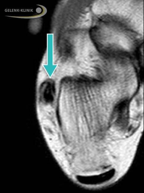 Riss der kurzen Peronealsehne