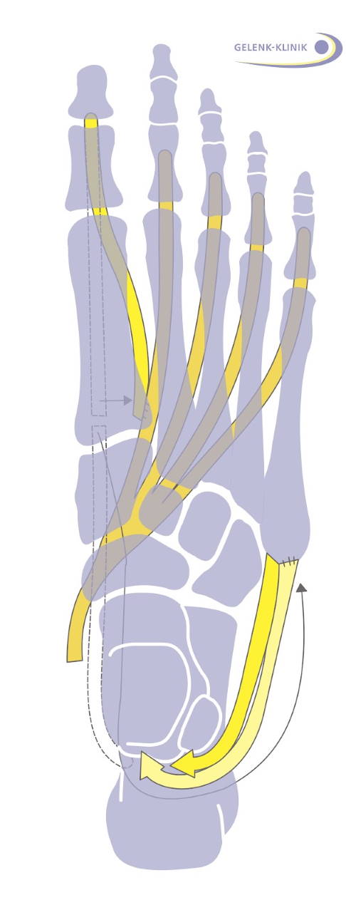 Charcot-Marie-Tooth: Symptome, Ursachen, Behandlung ...