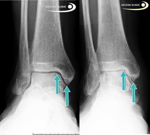 Arthrose des Sprunggelenks