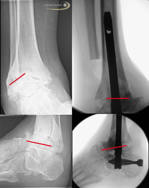 Röntgen: Stellungskorrektur des Sprunggelenks mit Marknagel