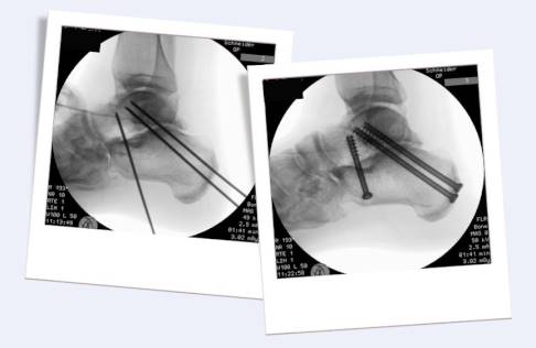 subtalare Arthrodese