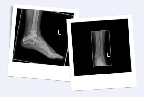 Subtalare Arthrodese im Röntgenbild von der Seite (links) und von vorne (rechts)
