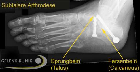 Röntgenbild der Subtalaren Arthrodese