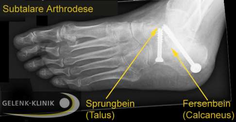 Röntgenbild der subtalaren Arthrodese