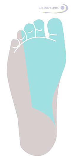 Tarsaltunnelsyndrom: Versorgungsgebiet des Tibialisnervs an der Innenseite der Fußsohle