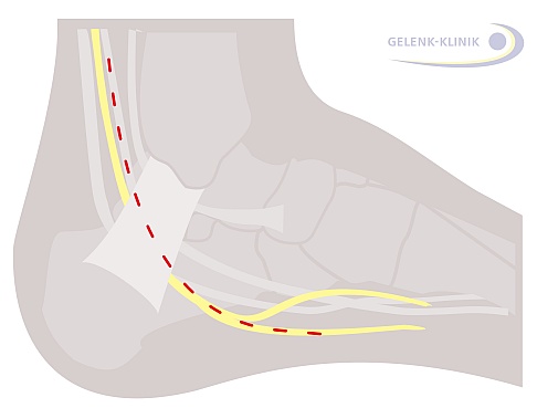 Tarsaltunnelsyndrom Nervenengpass Am Fuss Gelenk Klinik De