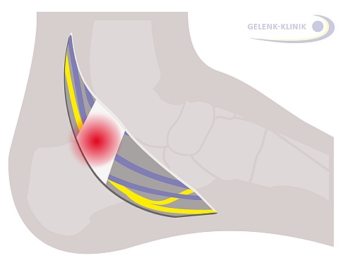 Tarsaltunnelsyndrom Nervenengpass Am Fuss Gelenk Klinik De