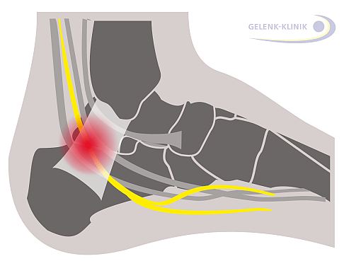 Anatomische Lage des Tarsaltunnels