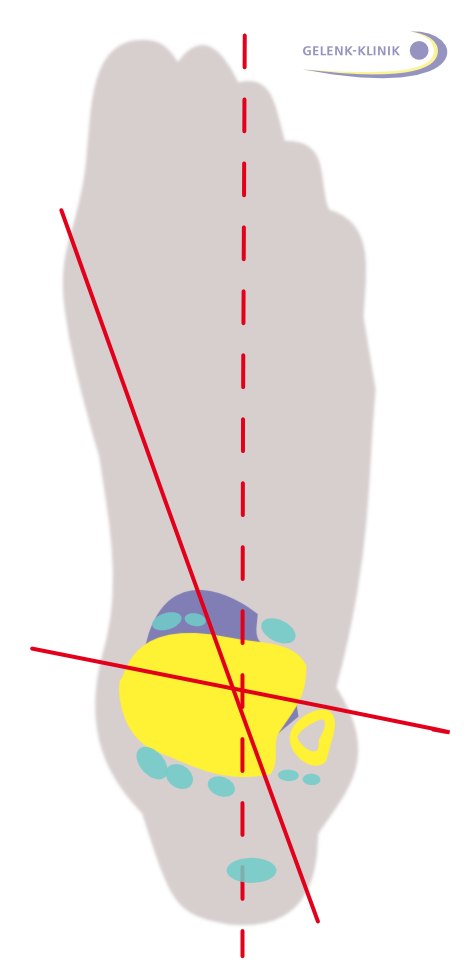 Bewegungsachsen des oberen und unteren Sprunggelenks: Die Sprunggelenksknochen sind angedeutet in gelb und violett dargestellt. Die Sehnenverläufe geben eine Auskunft über die Wirkung des Muskelzugs in Bezug auf die Bewegungsachsen. 
