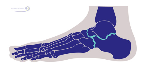Die Gelenk-Linien, die bei der Triple-Arthrodese versteift werden, sind in dieses Schema eingezeichnet. Das TALOCALCANEARE Gelenk (TCG) zwischen Sprungbein und Fersenbein und das TALONAVICULARE Gelenk (TNG) zwischen Sprungbein und Kahnbein und das Calcaneocuboidale Gelenk (CCG) zwischen Fersenbein und Würfelbein. © Viewmedica Schema Triple Arthrodese.