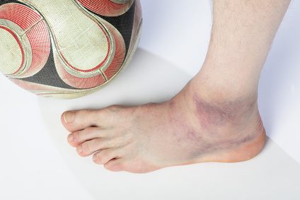 Sportmedizinische Verletzung.
