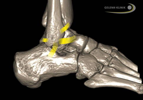 Внешние связки соединяют малоберцовую кость (Fibula) с пяточной и таранной костями. Межберцовый синдесмоз проходит между большеберцовой и малоберцовой костями. © Gelenk-Klinik