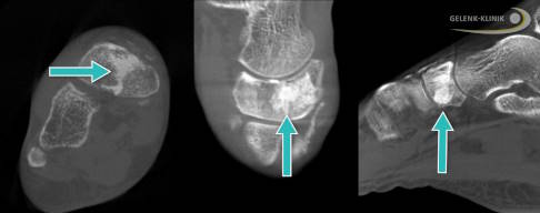 DVT nach Subspongiosaplastie.