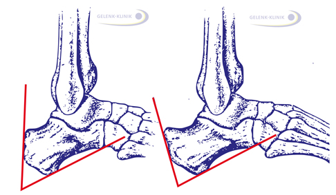 Fowler-Philips-Winkel zur Bestimmung der Ausprägung einer Haglundferse