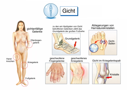 Gicht in verschiedenen Gelenken des Körpers