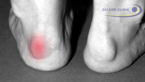 Haglund's syndrome is a deformity of the heel bone (calcaneus) which is also noticeable from the outside